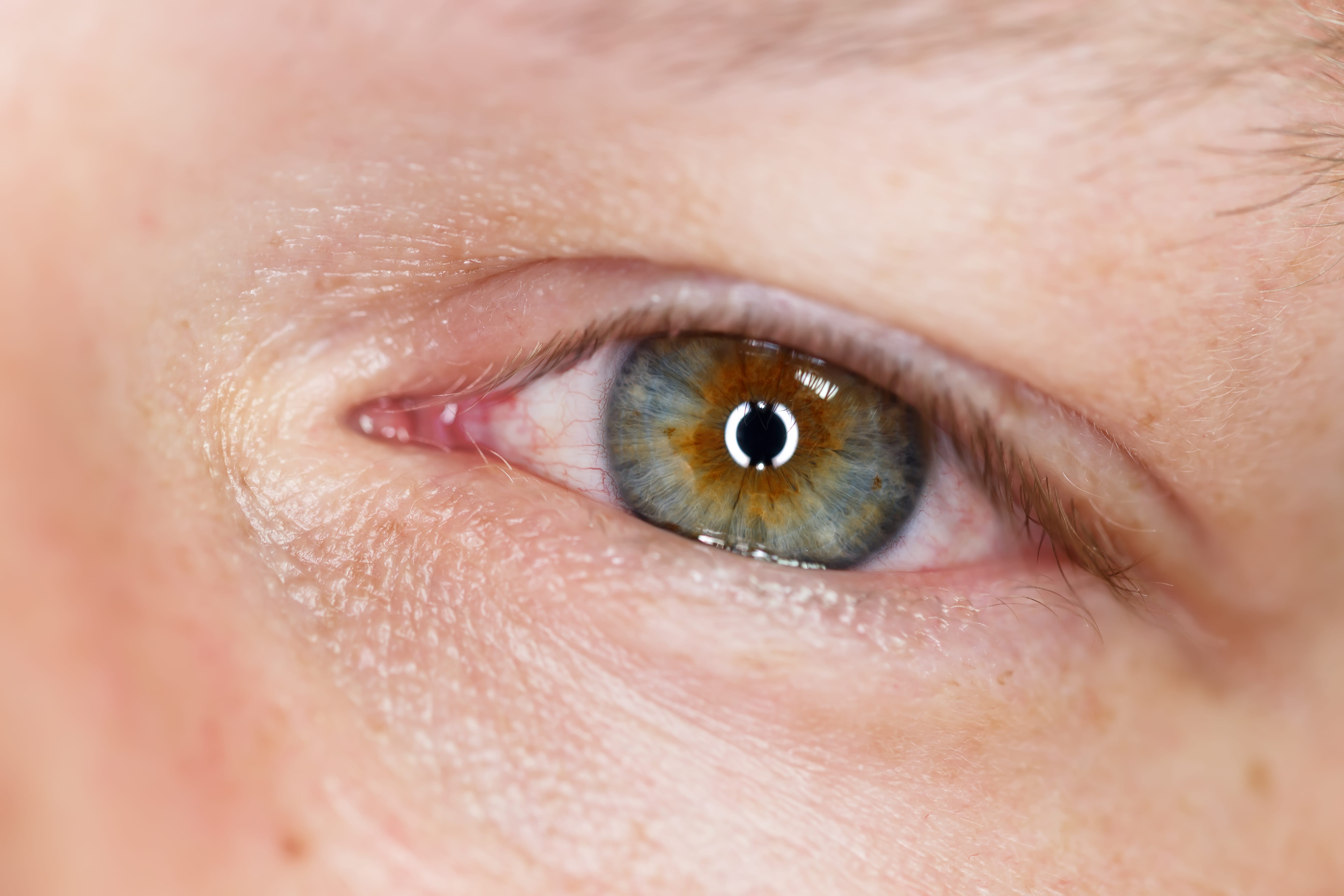 szemészeti kötőhártyagyulladás-kezelés